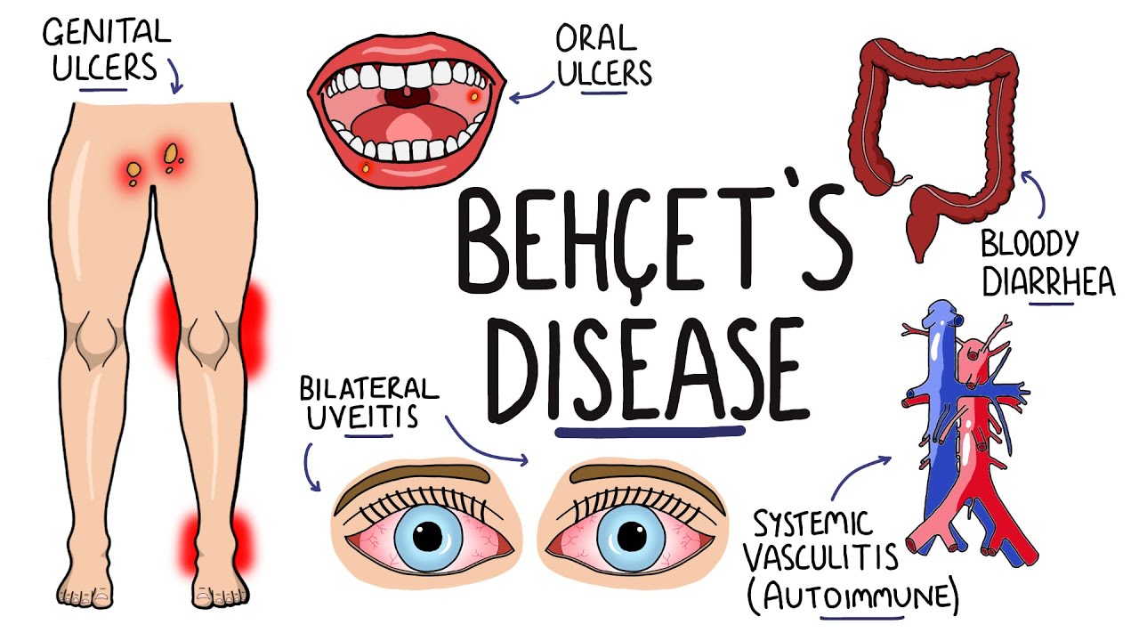 Behçet’s Disease