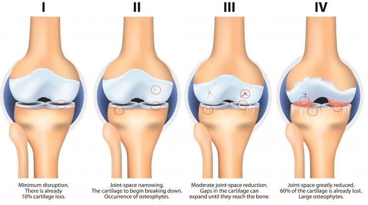 Osteoarthritis (OA)