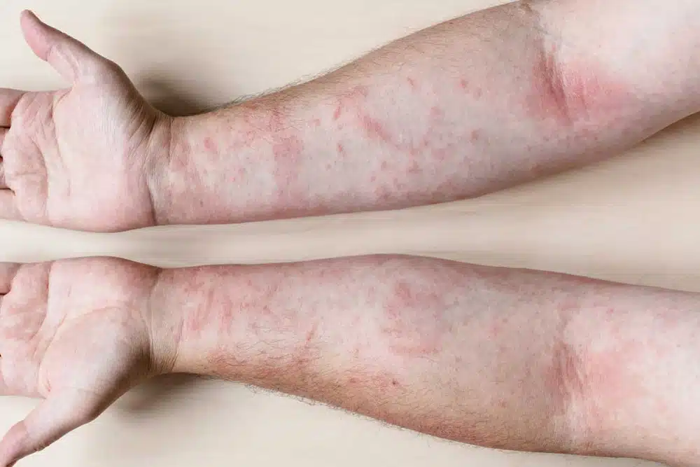 Psoriatic Arthritis