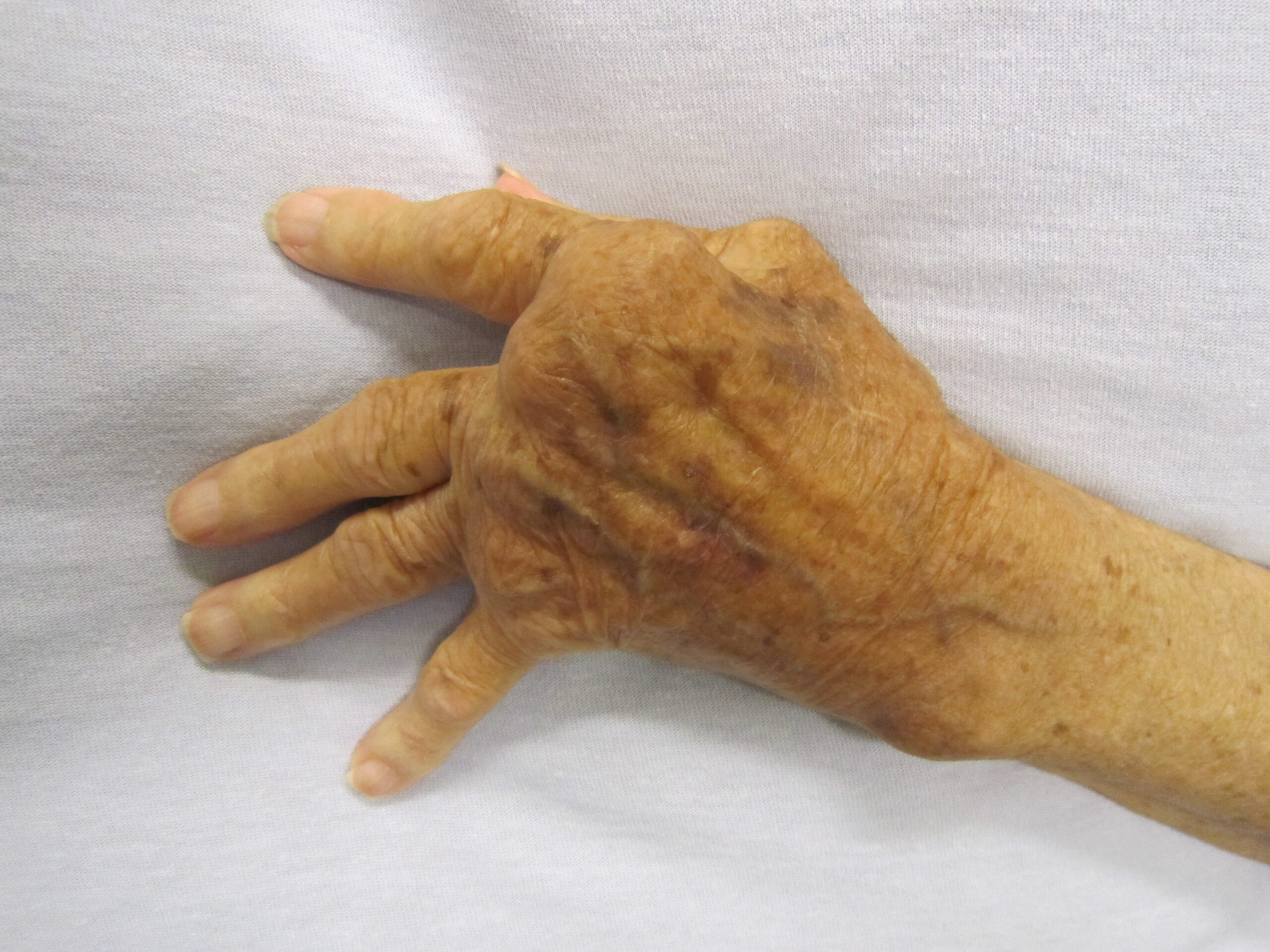 Rheumatoid Arthritis (RA)