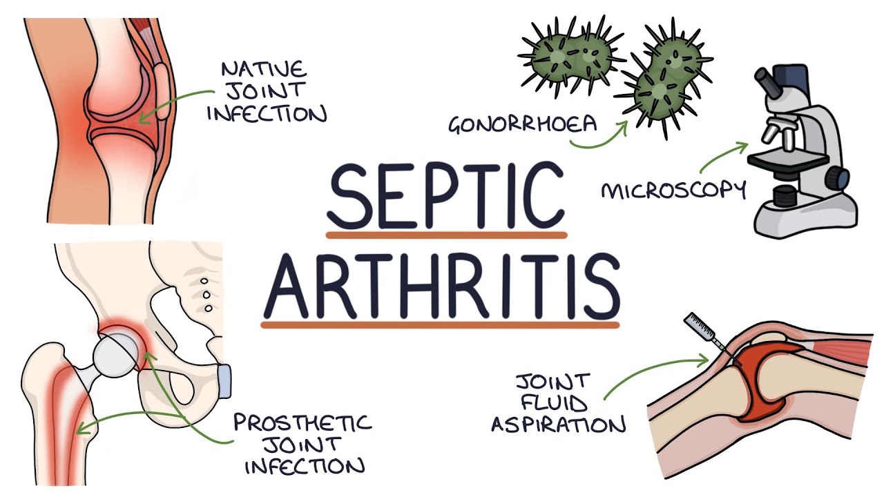 Septic Arthritis