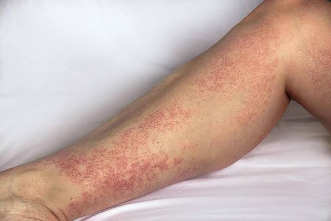 Vasculitis