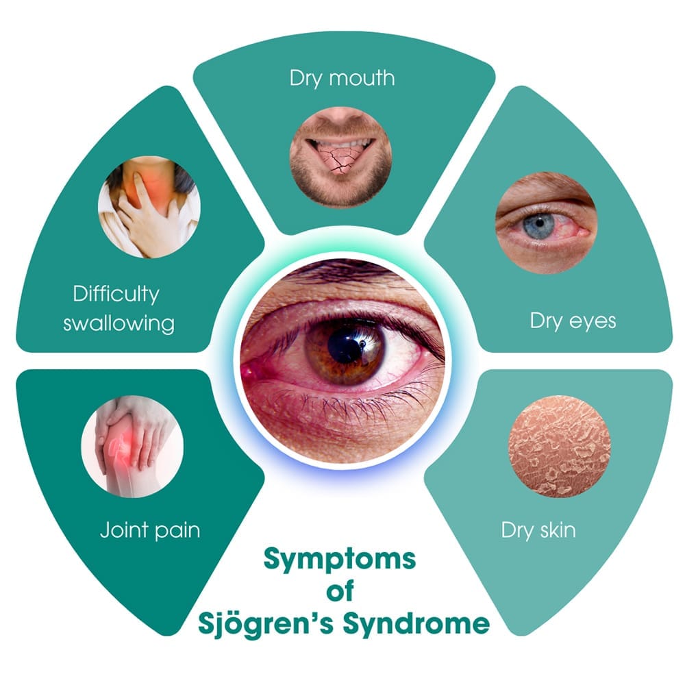 sjogrens-syndrome-symptoms
